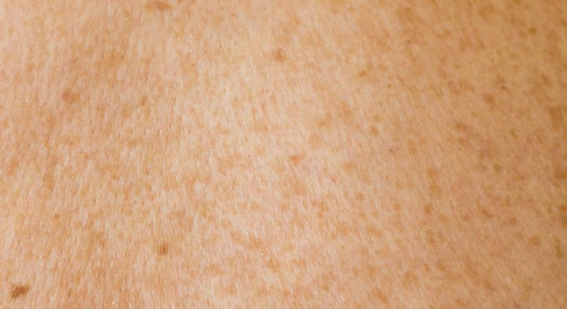 Mesterséges bőrt fejlesztettek égési sérültek gyógyítására
