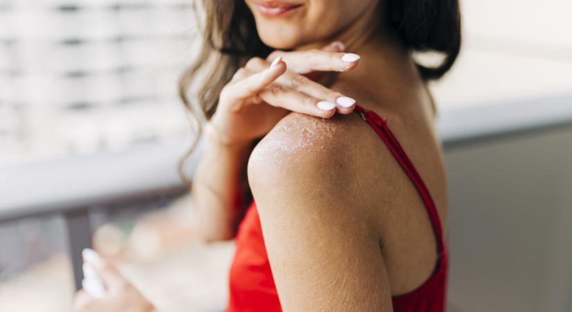 5 természetes SOS megoldás napégésre