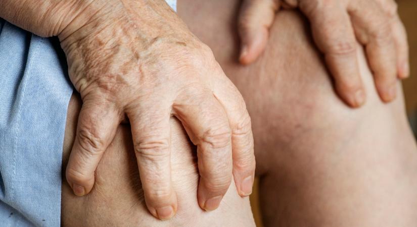 Mit tehetnek önmagukért a visszérbetegek a kánikulában?