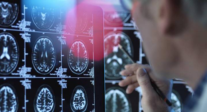 Így jelzi tested az Alzheimer-kór közeledtét