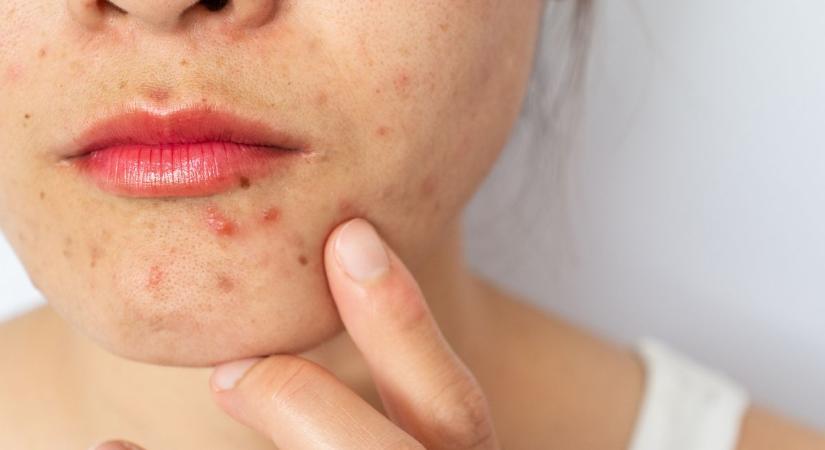 10 meglepő ok, ami felnőttkori pattanásokat okozhat – ezt teheted ellenük