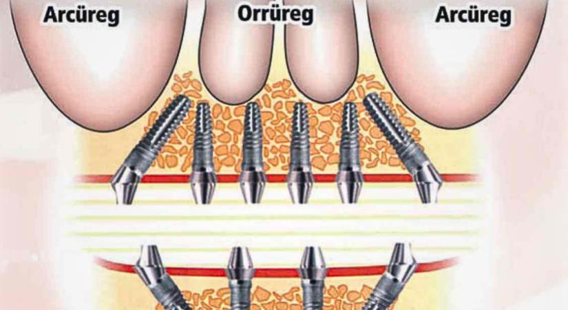 Egy nap alatt új mosoly? – így zajlik az All-on-4 kezelési folyamat a győri Dent Art Klinikán