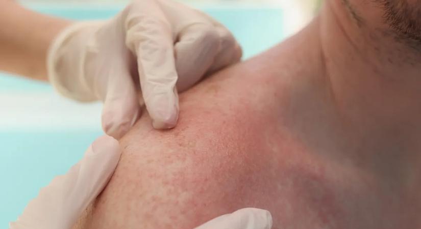 Furcsa foltok a bőrödön? Erre a különös betegségre utalhat