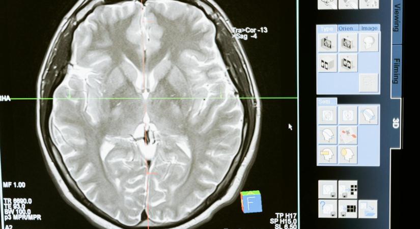 Kritikus részletekre bukkantak kutatók az Alzheimer-kór kapcsán