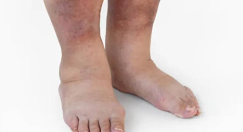 A meleg fokozza a vérrögképződés kockázatát – kik a veszélyeztetettek?