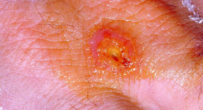 Rendkívül ragályos pestis terjed Németországban