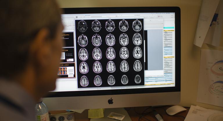 Áttörés az Alzheimer-kutatásban, új korszak kezdődhet a gyógyításban