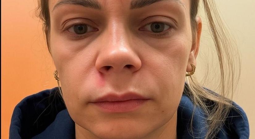 Azonnal kórházba került: A "halál háromszögében" nőtt pattanás törölte le a mosolyt a nő arcáról
