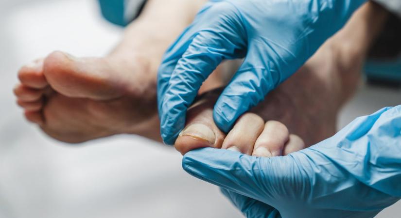 Fehér, sárga foltok a körmödön? Így ismerheted fel a gombás fertőzés jeleit