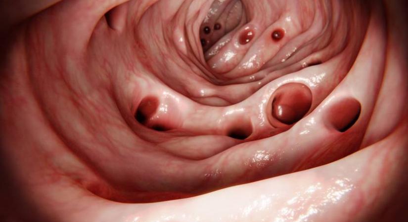 Súlyos elváltozás állhat a hasi fájdalom mögött: egyre többeket érint a vastagbél-diverticulosis