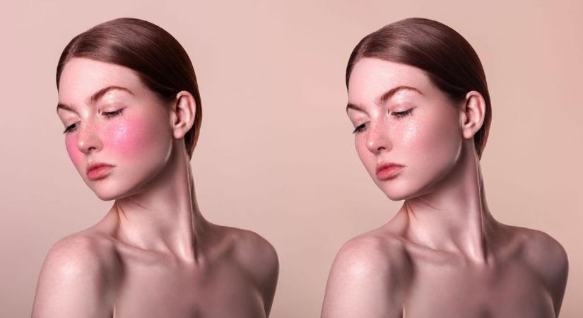 Rosacea: minden, amit tudnod kell a piros arcbőr kezeléséről