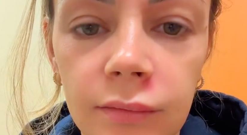 Az arc "halál háromszögében" nyomta ki a pattanását a nő: durva vége lett - Videó