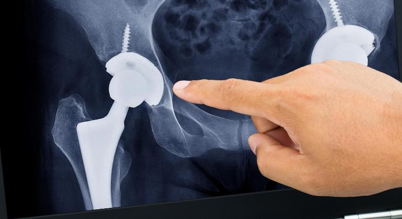 Hat-hét évet szenved egy átlagos magyar beteg, mire a diagnózistól eljut egy térdprotézis-műtétig, amelyre orvos helyett doktor Google készíti fel
