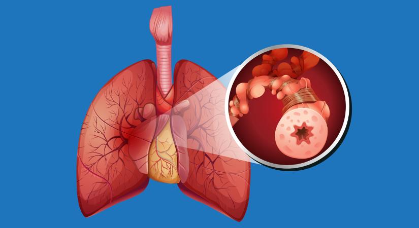 Első alkalommal rendezik meg a COPD Országos Találkozót