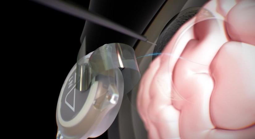 Neuralink: Elon Musk agyimplantátumai már egy tucat páciensen segítettek?