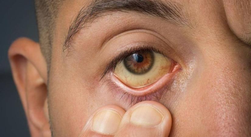 Drámaian terjed a hepatitis A Borsodban: bezártak egy óvodát, százakat oltanak