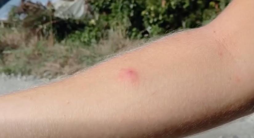 Parazita fészkelt egy magyar férfi bőre alá: orvosok vágták ki