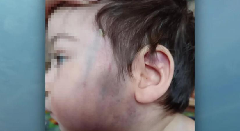 Eltussolnák ezt is? Súlyosan összeverhettek egy másfél éves kisfiút a szekszárdi gyermekotthonban