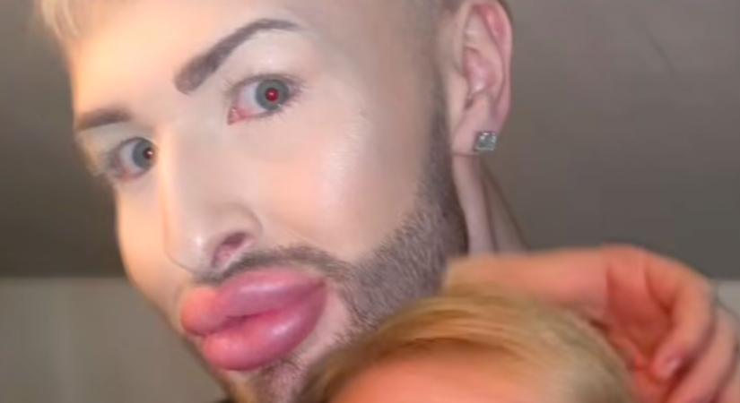 Éveken át botoxoltatta az arcát a férfi - így néz ki ma - Videó