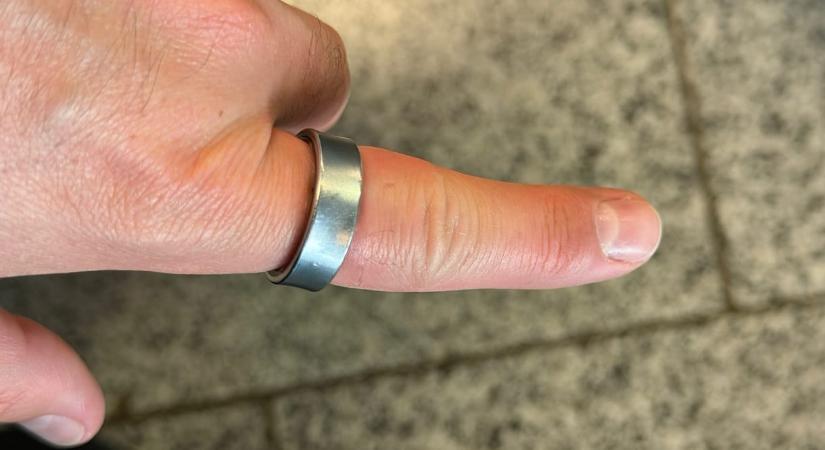 Megsérült az akkumulátor, rászorult a Samsung okosgyűrűje a felhasználó ujjára – fotók