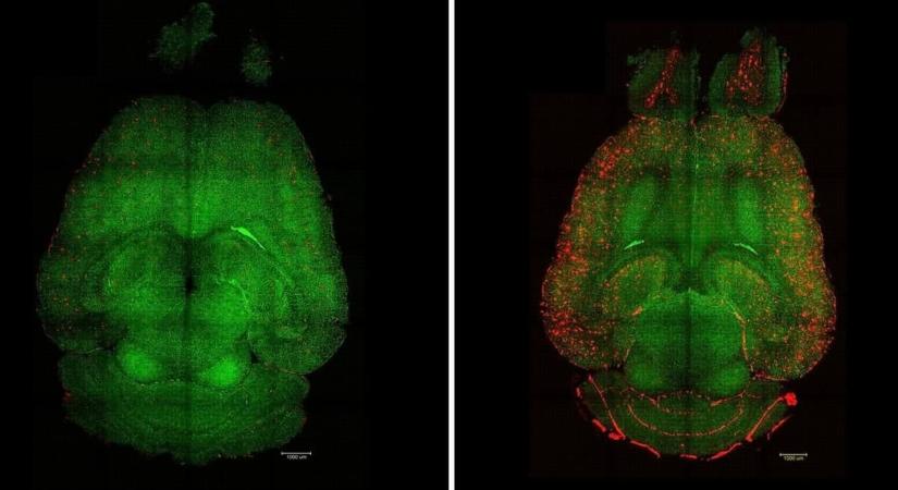 Sikerült lefegyverezni az Alzheimer-kórt, egy oltás elég volt hozzá