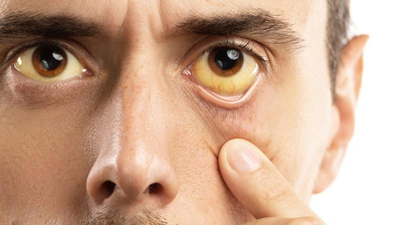 Az óvintézkedések betartására hívják fel a figyelmet az A típusú hepatitis megbetegedéssel szemben