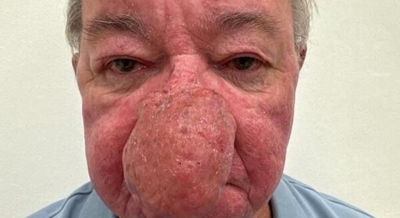 Évekig nem tudta megcsókolni a feleségét a nagypapa brutális bőrbetegsége miatt
