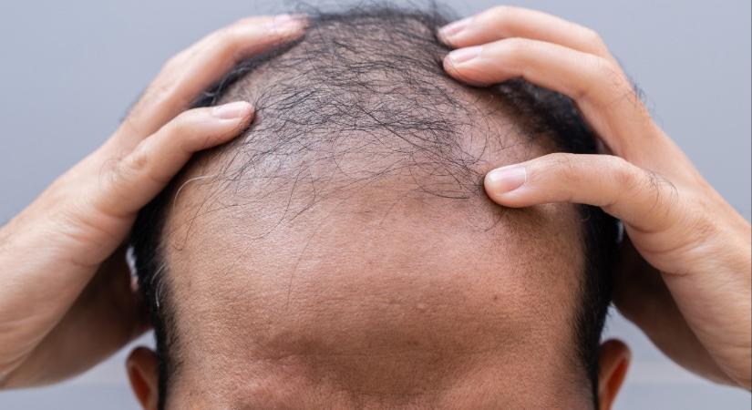 Friss felfedezés: erre vártak a hajhullással küzdők
