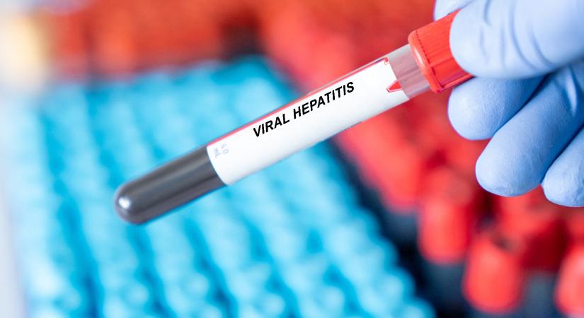 Hepatitis A-járvány: tovább terjed a fertőzés, egyelőre nem sikerült megfékezni