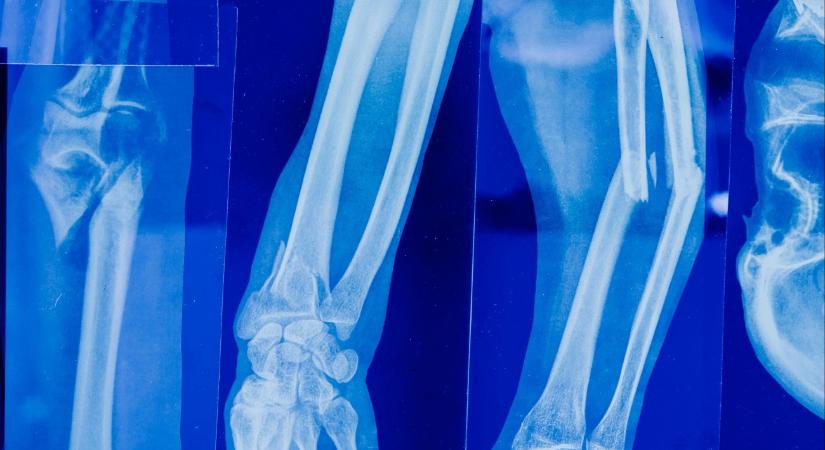 Döbbenetes magyarázatot adtak a bölcsődei dolgozók az eltört lábú kisfiú édesanyjának