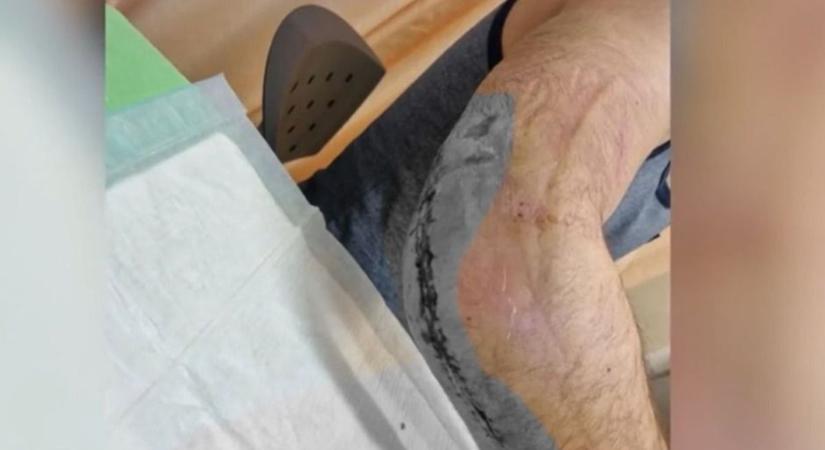 „Csavarok tartják össze a karomat” Rémálommá vált az élete egy borsodi férfinak, miután majdnem leszakadt a karja (videóval)