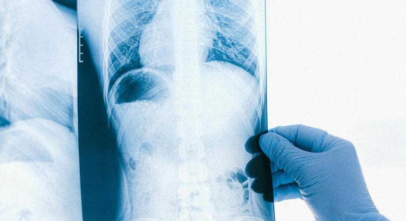 Mellrákot diagnosztizáltak a férfinál – egyetlen tünete volt