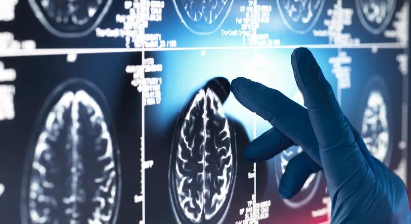 Olyan dolgot találtak az Alzheimer-kóros agyban, amire még a tudósok sem számítottak
