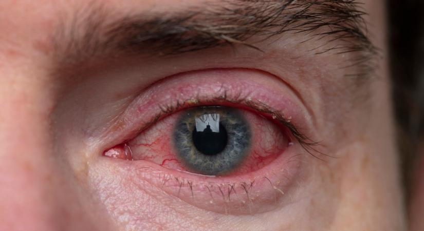 Nem csak fáradtság! A duzzadt, piros szem akár vesebetegségre is utalhat