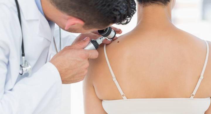 Az ilyen anyajegy több mint gyanús – műtétet fog javasolni orvosod