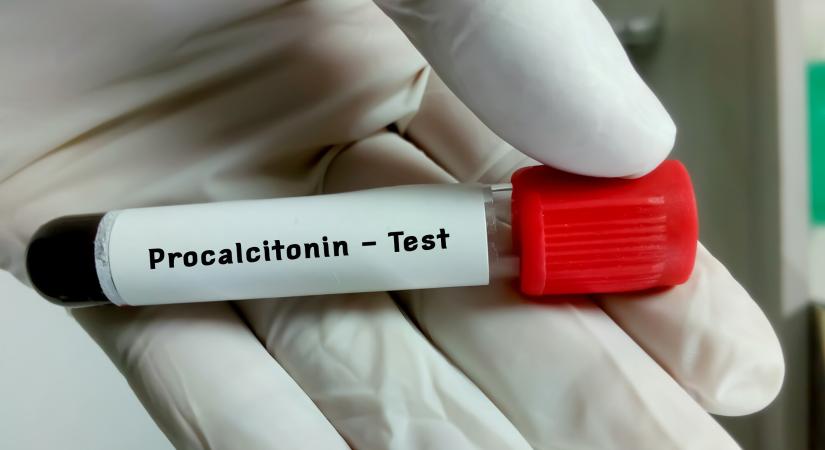 PCT-szint a laborleleten: mit mutat meg? – Ezért kérheti az orvos