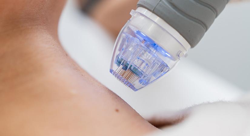 Ez a kezelés serkenti a bőr kollagéntermelését - tényleg hatásos