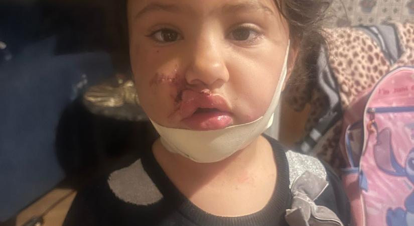 Borzalmas kutyatámadás: 4 éves kislány arcát marcangolta egy megvadult pitbull