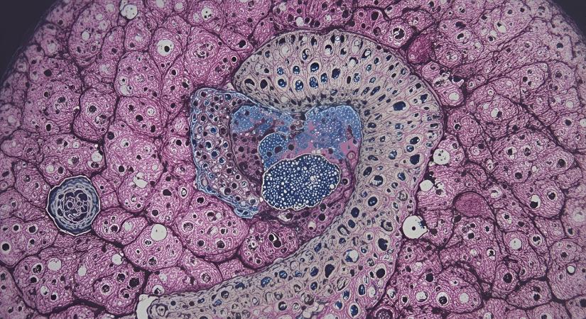 Viták a NEN-ben: Az ENETS állásfoglalása a Grade 3, jól differenciált, gasztroenteropankreatikus neuroendokrin daganatban szenvedő betegek kezeléséről