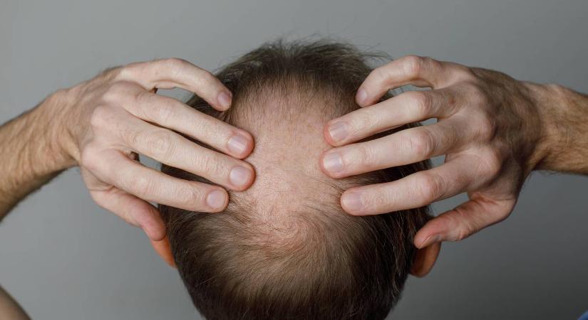 A tudósok új gyógymódot fedeztek fel a hajhullás ellen – mindössze 20 nap alatt hat