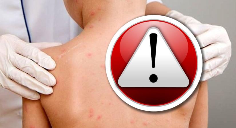 Októberben 64 új kanyarós esetet jelentettek