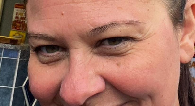 „Minden étkezés szenvedés” – Fogorvosa tönkretette a nő életét