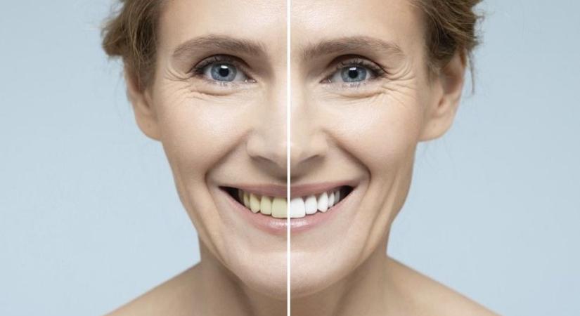 Fogfehérítés otthon: ezeket a módszereket kerülje el!