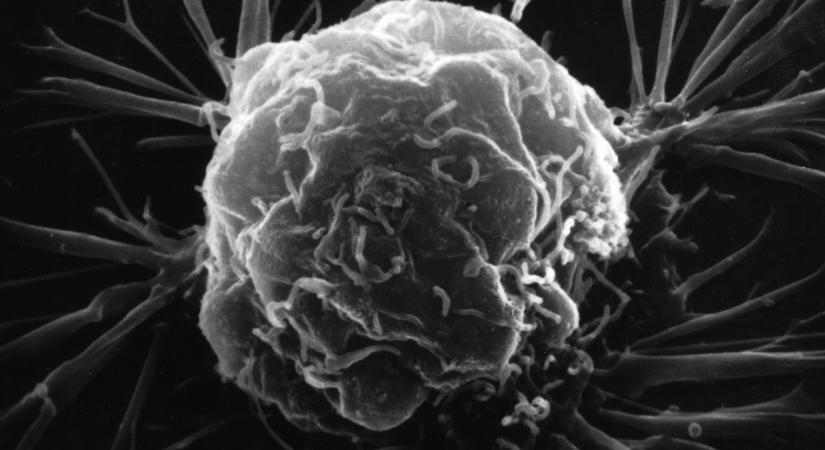 Megjósolható lehet, hogy mekkora eséllyel alakul ki szívbetegség a mellrák kezelése után