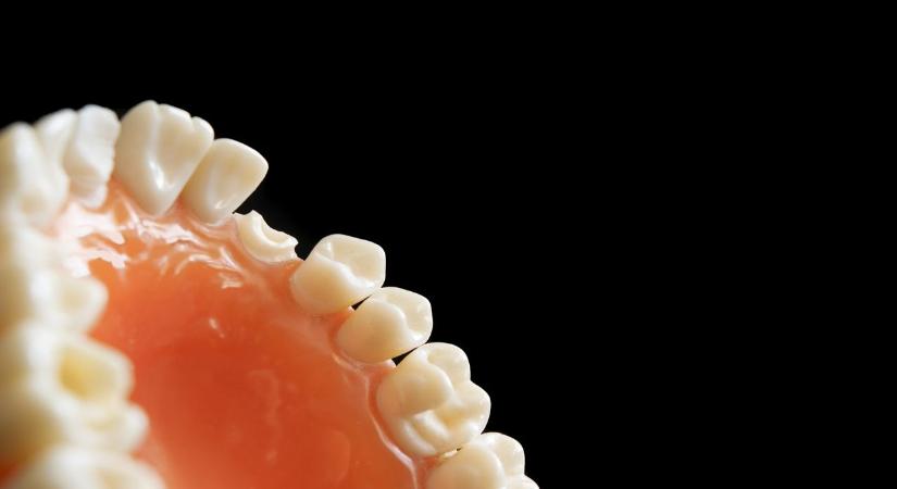 Fogzománcot helyreállító anyagot találtak a kutatók