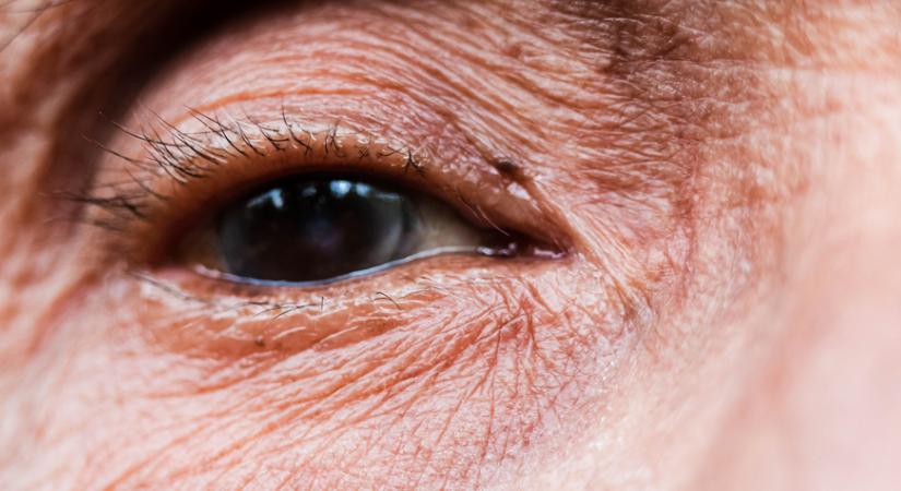 Meglepő ok az időskori könnyezés mögött!