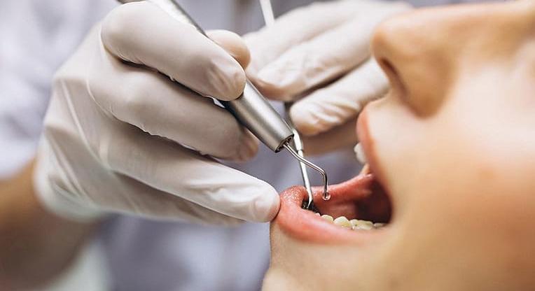 Nagyobb eséllyel kap stroke-ot, akinek rosszak a fogai