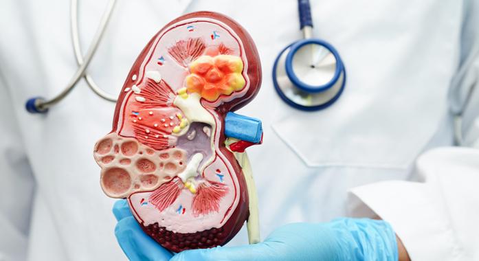 A Wilms tumor, vagyis a vesedaganat