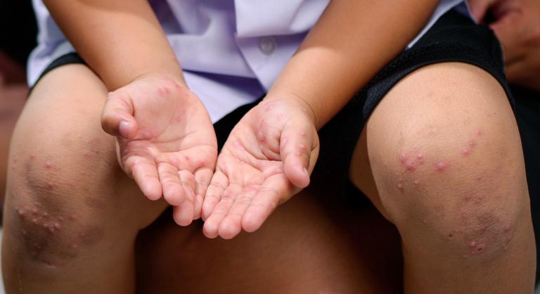 Fertőző vírus terjed a szomszédos országban, a gyerekek a legveszélyeztetettebbek