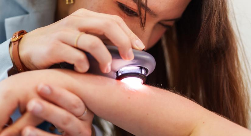 Apró jel, nagy veszély – így ismerheted fel a melanoma első tüneteit